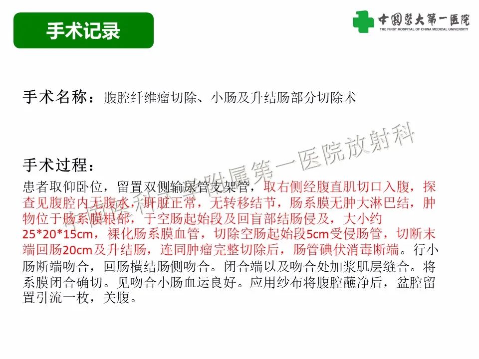 影像PPT - 【病例】腹腔韧带样纤维瘤病1例CT影像-8