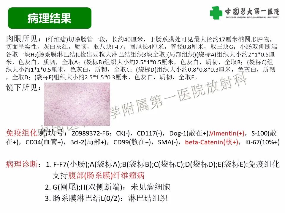 影像PPT - 【病例】腹腔韧带样纤维瘤病1例CT影像-9