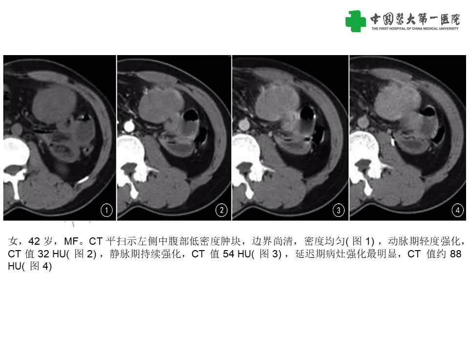 影像PPT - 【病例】腹腔韧带样纤维瘤病1例CT影像-16