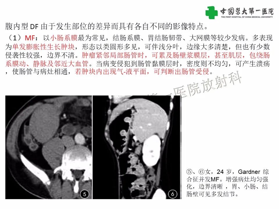 影像PPT - 【病例】腹腔韧带样纤维瘤病1例CT影像-15