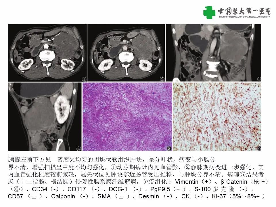 影像PPT - 【病例】腹腔韧带样纤维瘤病1例CT影像-17