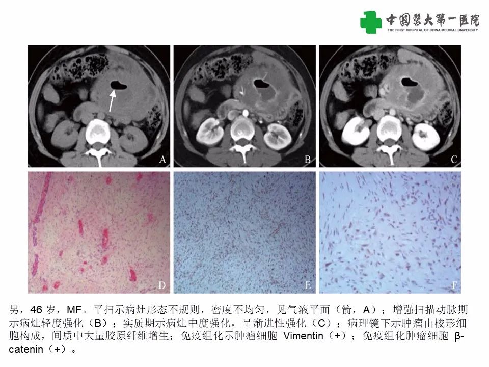 影像PPT - 【病例】腹腔韧带样纤维瘤病1例CT影像-18