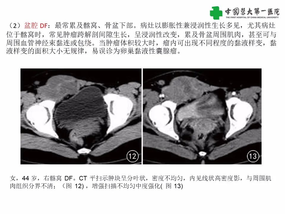 影像PPT - 【病例】腹腔韧带样纤维瘤病1例CT影像-19
