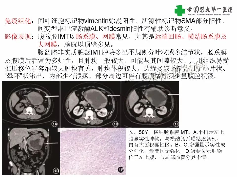 影像PPT - 【病例】腹腔韧带样纤维瘤病1例CT影像-23