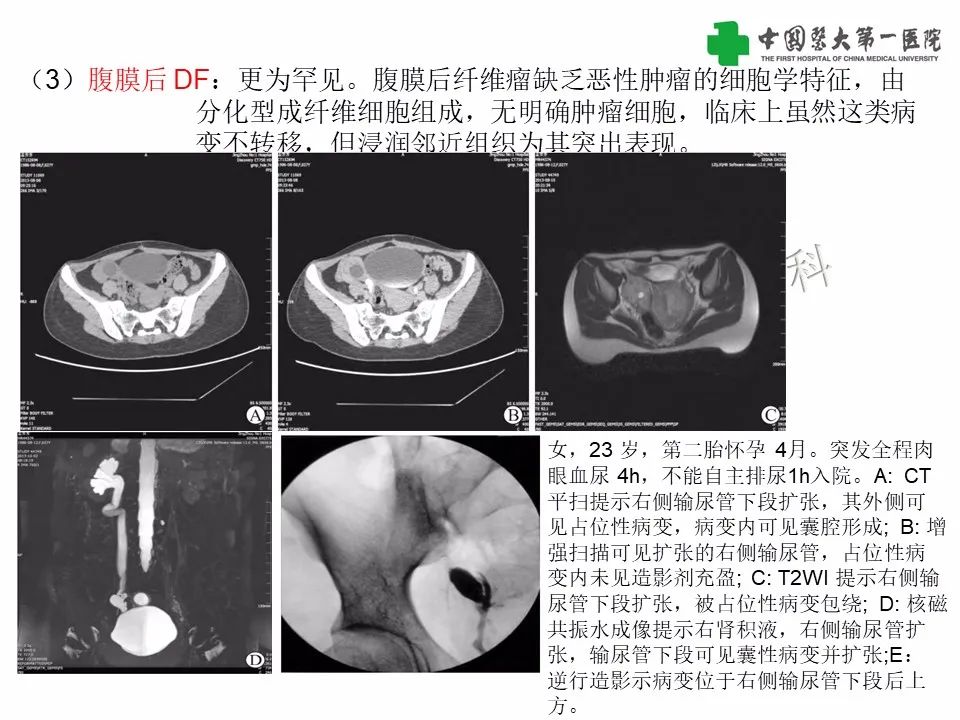 影像PPT - 【病例】腹腔韧带样纤维瘤病1例CT影像-21