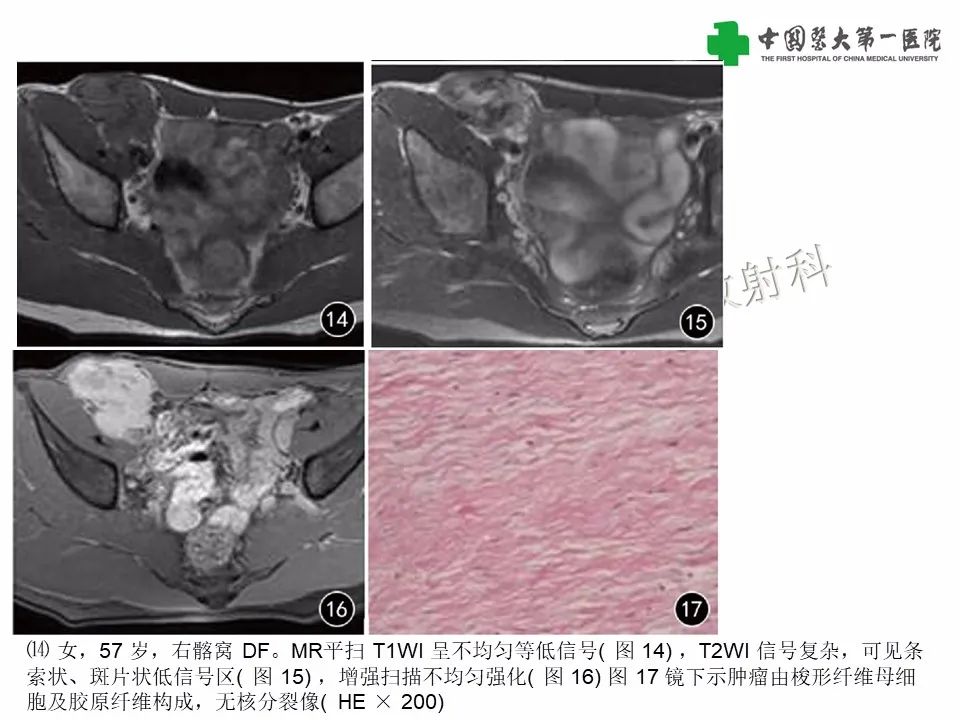 影像PPT - 【病例】腹腔韧带样纤维瘤病1例CT影像-20