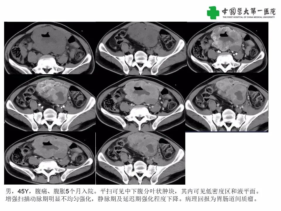 影像PPT - 【病例】腹腔韧带样纤维瘤病1例CT影像-25