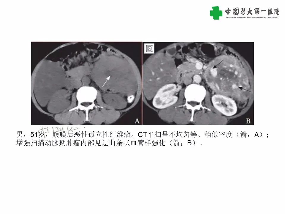 影像PPT - 【病例】腹腔韧带样纤维瘤病1例CT影像-27