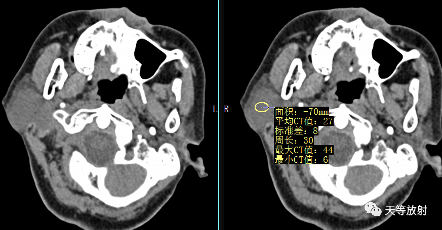 影像PPT - 【病例】腮腺多形性腺瘤2例CT影像-4 影像PPT - 【病例】腮腺多形性腺瘤2例CT影像-4