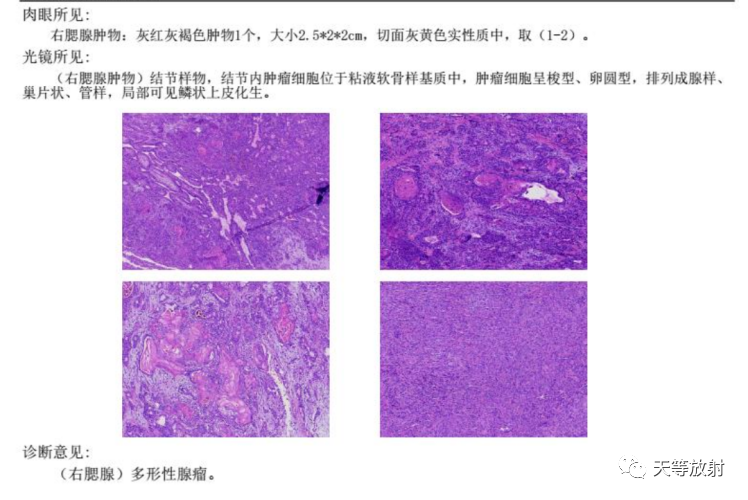 影像PPT - 【病例】腮腺多形性腺瘤2例CT影像-3 影像PPT - 【病例】腮腺多形性腺瘤2例CT影像-3