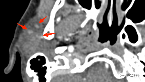 影像PPT - 【病例】腮腺多形性腺瘤2例CT影像-6 影像PPT - 【病例】腮腺多形性腺瘤2例CT影像-6