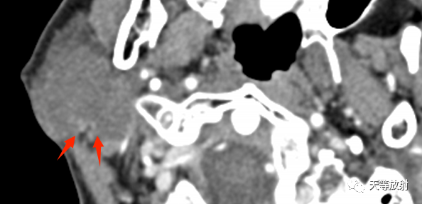 影像PPT - 【病例】腮腺多形性腺瘤2例CT影像-7 影像PPT - 【病例】腮腺多形性腺瘤2例CT影像-7