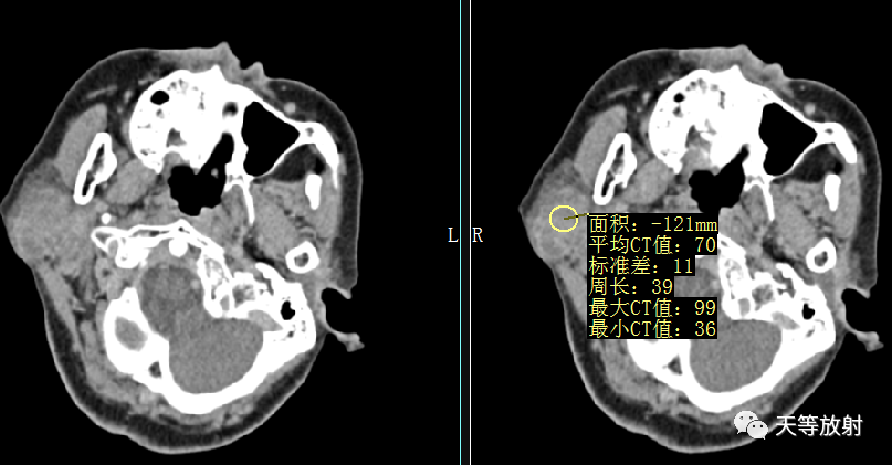 影像PPT - 【病例】腮腺多形性腺瘤2例CT影像-8 影像PPT - 【病例】腮腺多形性腺瘤2例CT影像-8