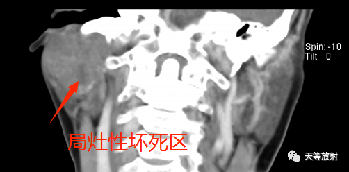 影像PPT - 【病例】腮腺多形性腺瘤2例CT影像-9 影像PPT - 【病例】腮腺多形性腺瘤2例CT影像-9