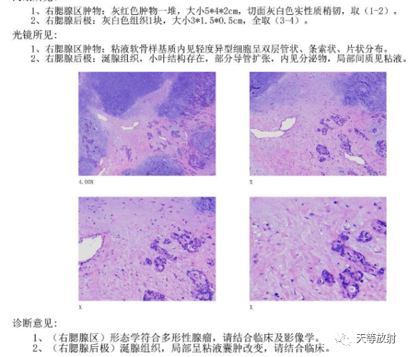影像PPT - 【病例】腮腺多形性腺瘤2例CT影像-10 影像PPT - 【病例】腮腺多形性腺瘤2例CT影像-10