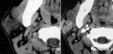 影像PPT - 【病例】腮腺多形性腺瘤2例CT影像-13 影像PPT - 【病例】腮腺多形性腺瘤2例CT影像-13