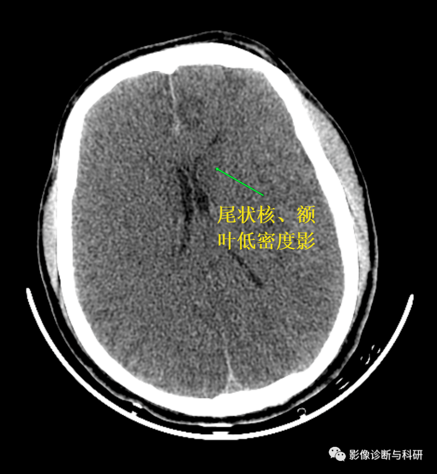 影像PPT - 【病例】假性蛛网膜下腔出血1例CT表现-2 影像PPT - 【病例】假性蛛网膜下腔出血1例CT表现-2