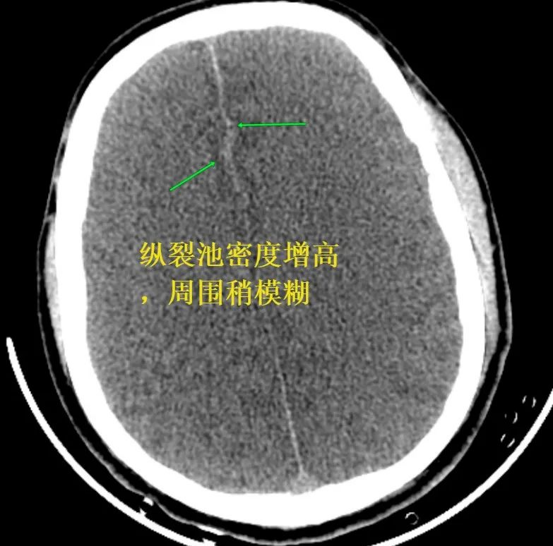 影像PPT - 【病例】假性蛛网膜下腔出血1例CT表现-3 影像PPT - 【病例】假性蛛网膜下腔出血1例CT表现-3