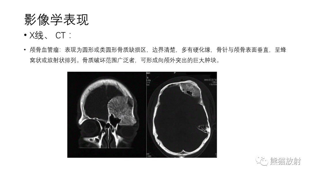 影像PPT - 【病例】骨血管瘤2例X线CT及MR影像-18