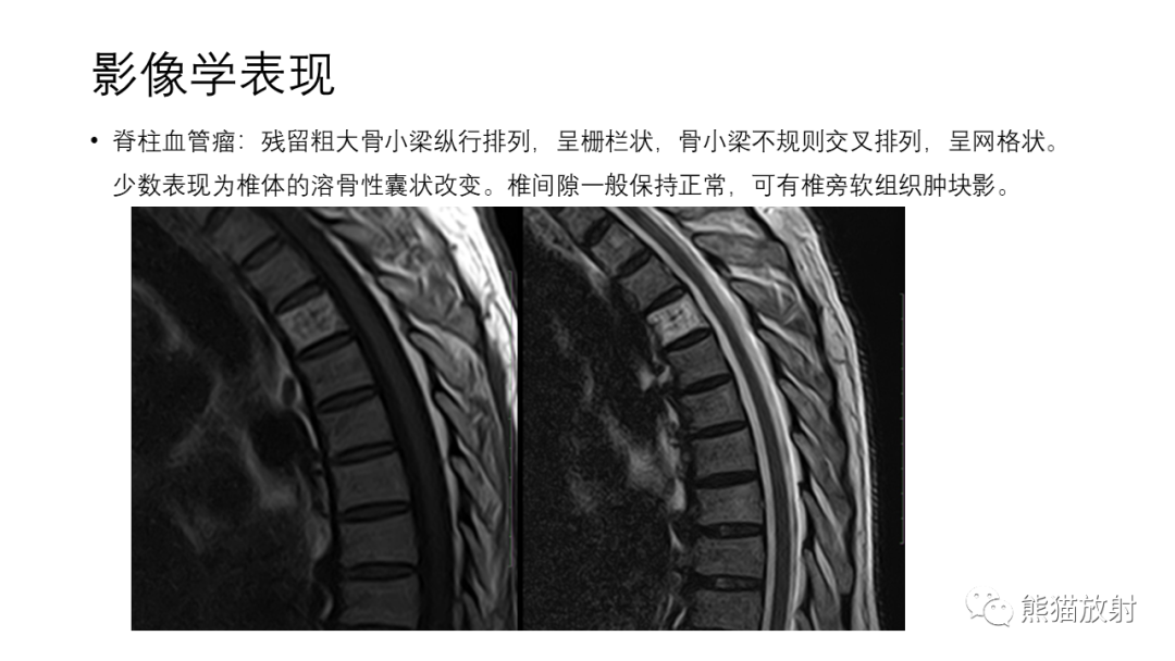 影像PPT - 【病例】骨血管瘤2例X线CT及MR影像-19