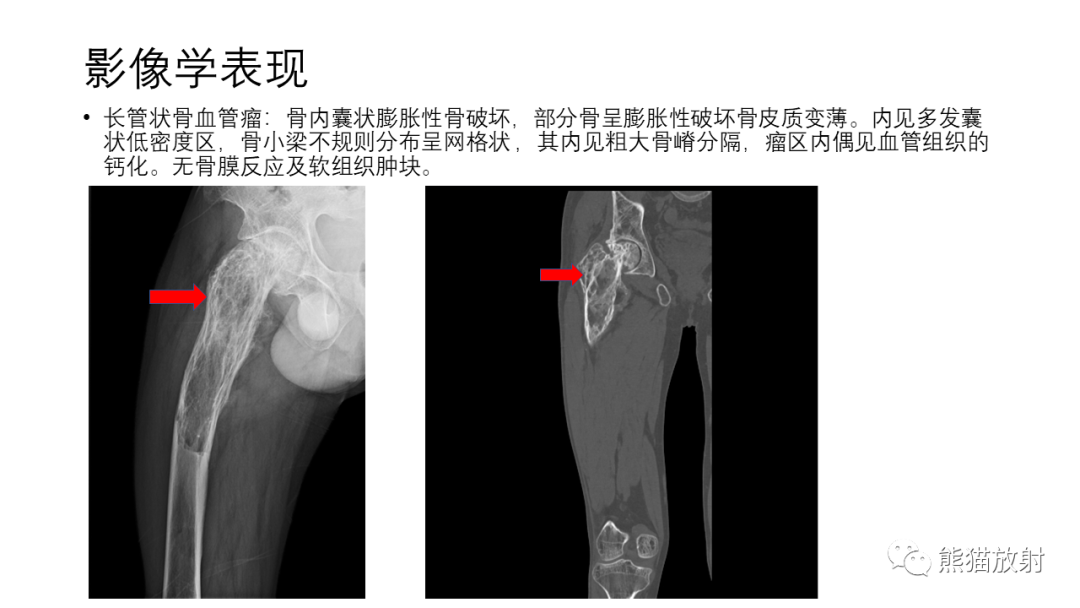 影像PPT - 【病例】骨血管瘤2例X线CT及MR影像-20