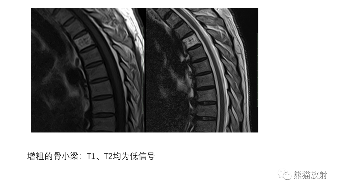 影像PPT - 【病例】骨血管瘤2例X线CT及MR影像-22