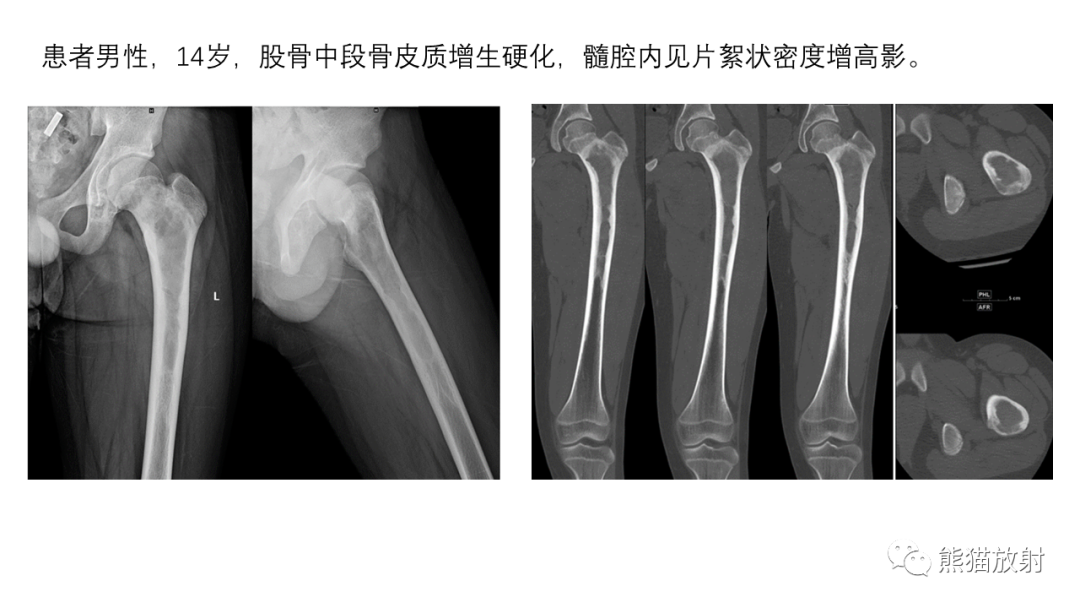 影像PPT - 【病例】骨血管瘤2例X线CT及MR影像-25
