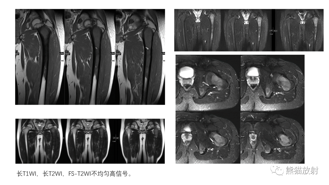 影像PPT - 【病例】骨血管瘤2例X线CT及MR影像-26
