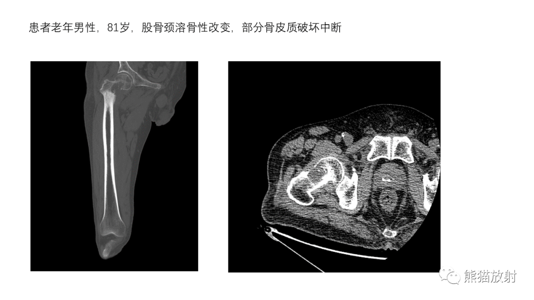 影像PPT - 【病例】骨血管瘤2例X线CT及MR影像-29
