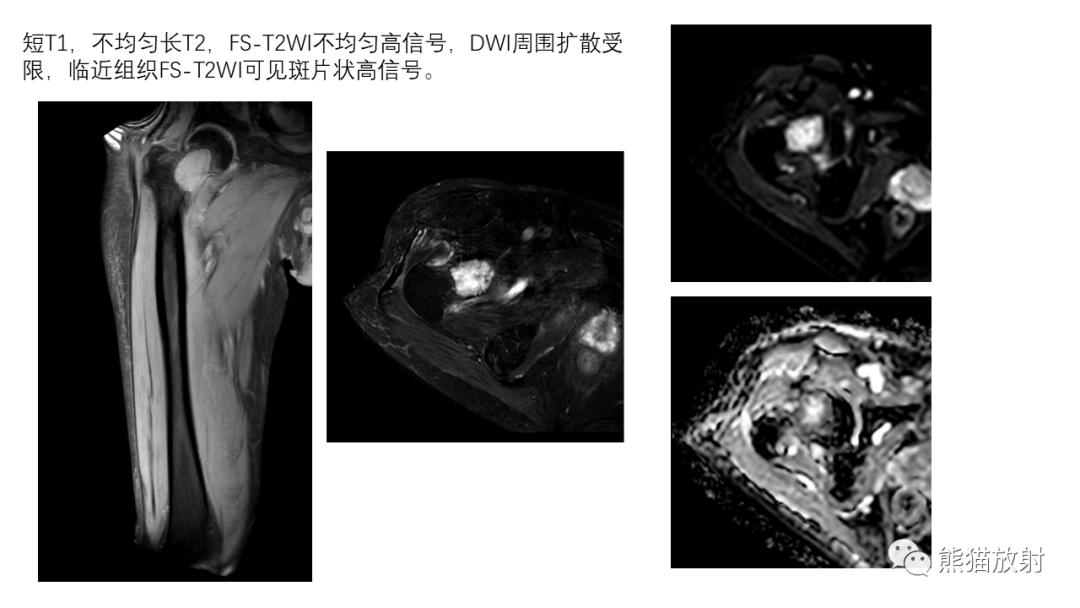 影像PPT - 【病例】骨血管瘤2例X线CT及MR影像-30