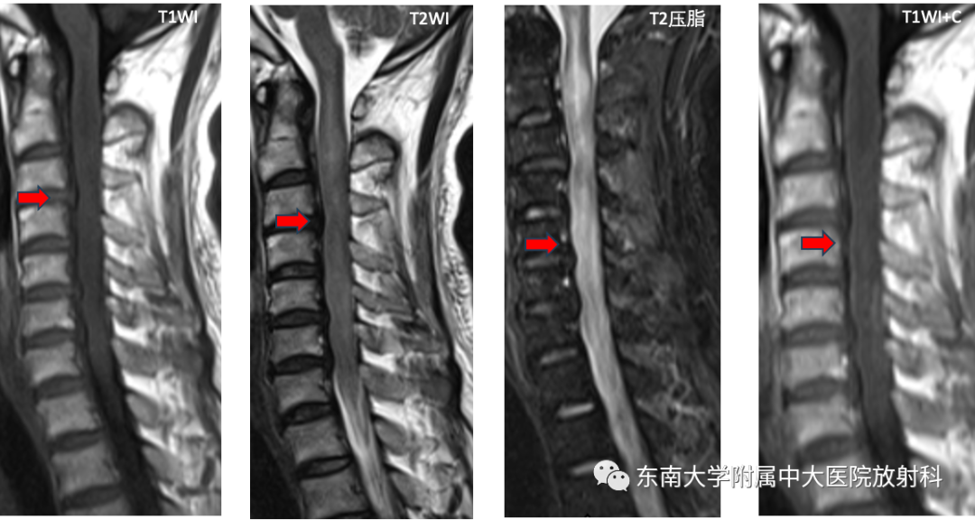 影像PPT - 【PPT】脊髓星形细胞瘤-3