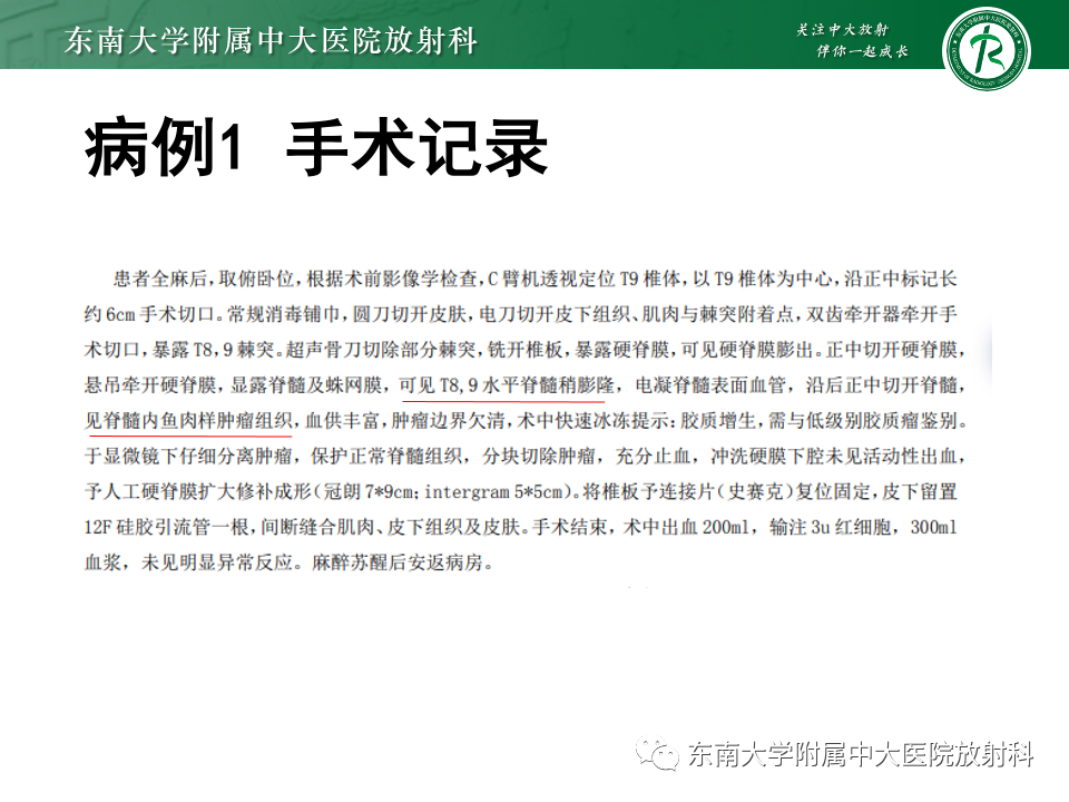 影像PPT - 【PPT】脊髓星形细胞瘤-4