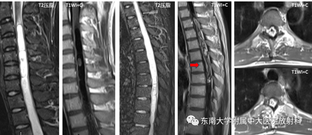 影像PPT - 【PPT】脊髓星形细胞瘤-2