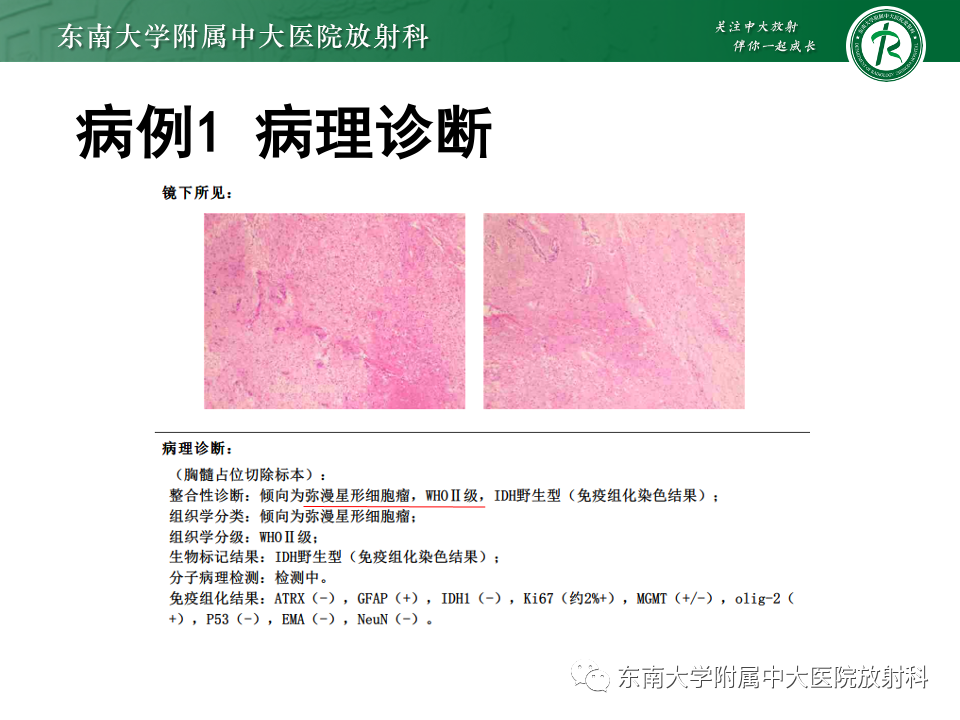 影像PPT - 【PPT】脊髓星形细胞瘤-5