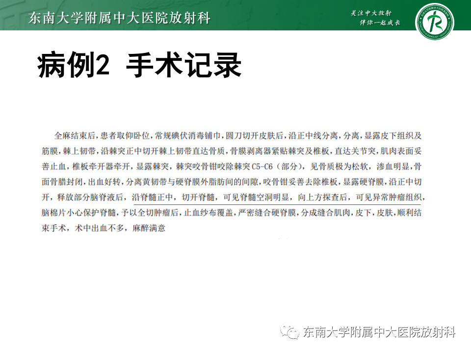影像PPT - 【PPT】脊髓星形细胞瘤-6