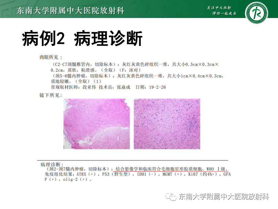 影像PPT - 【PPT】脊髓星形细胞瘤-7