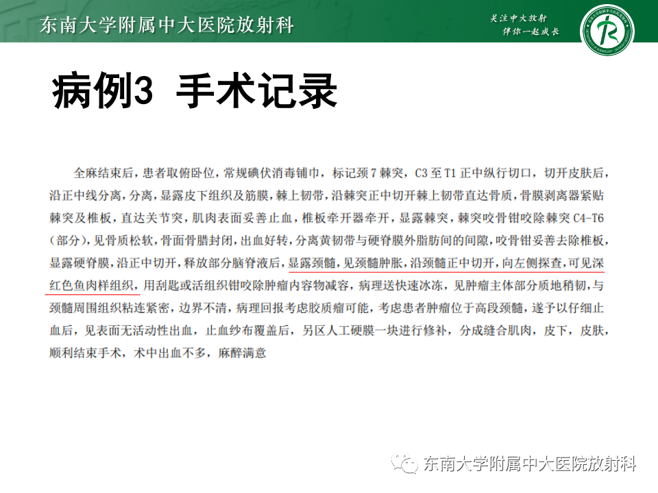 影像PPT - 【PPT】脊髓星形细胞瘤-8