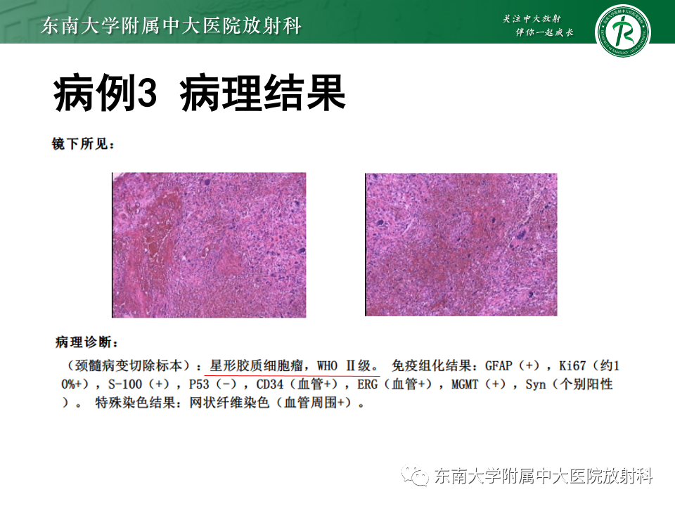 影像PPT - 【PPT】脊髓星形细胞瘤-9