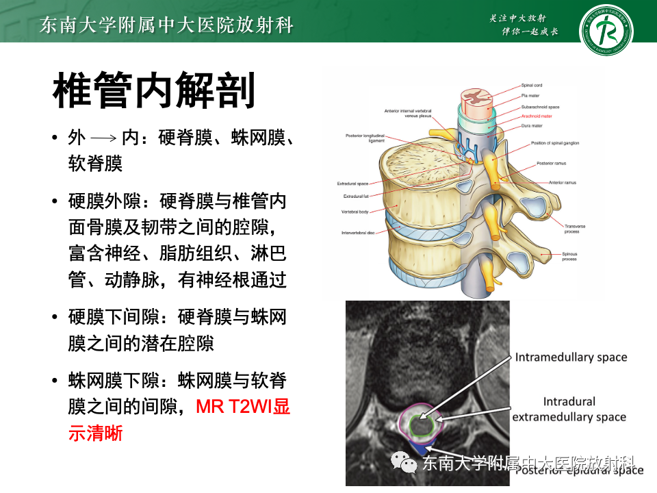 影像PPT - 【PPT】脊髓星形细胞瘤-12