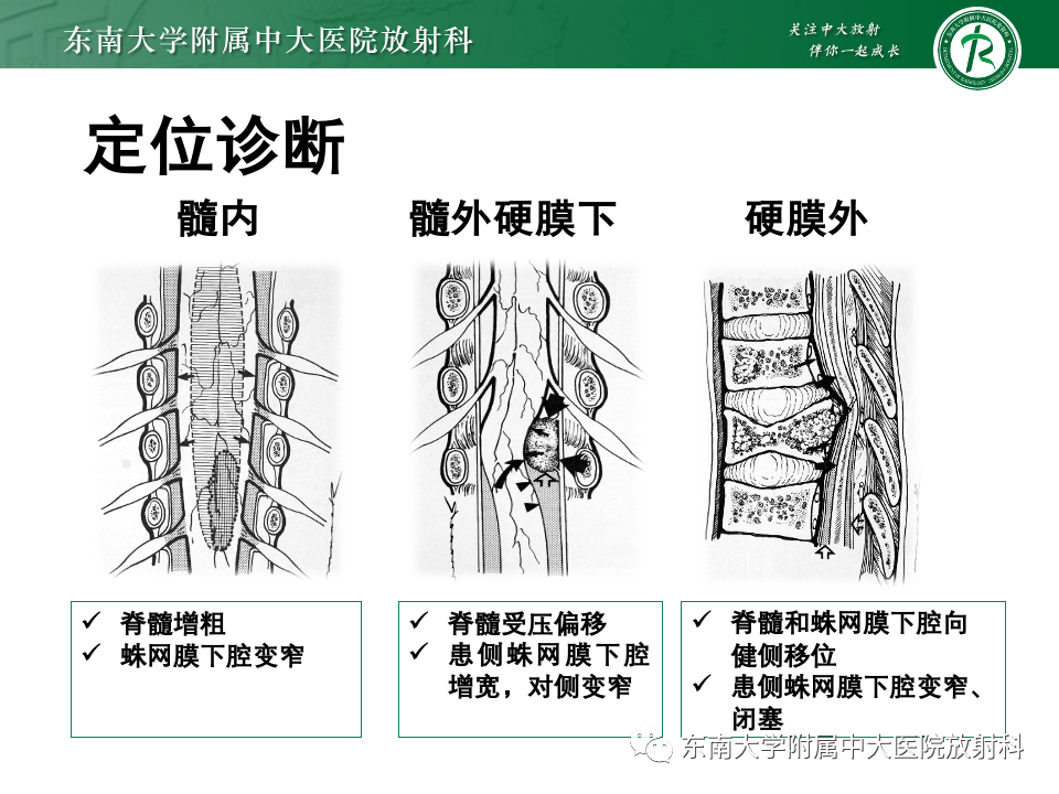 影像PPT - 【PPT】脊髓星形细胞瘤-13