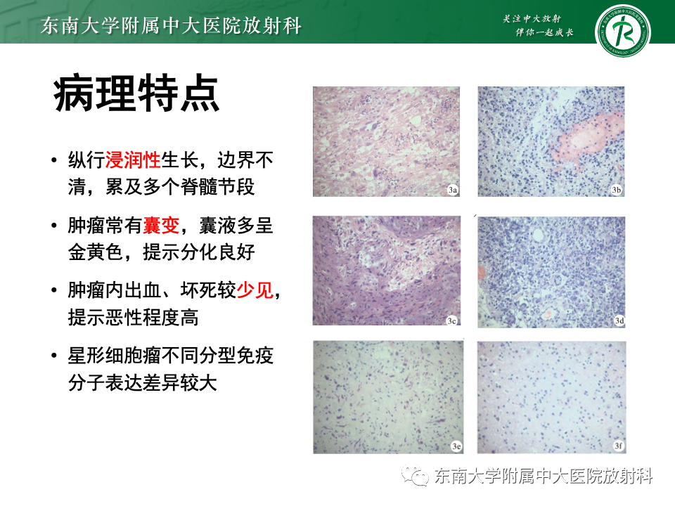 影像PPT - 【PPT】脊髓星形细胞瘤-17