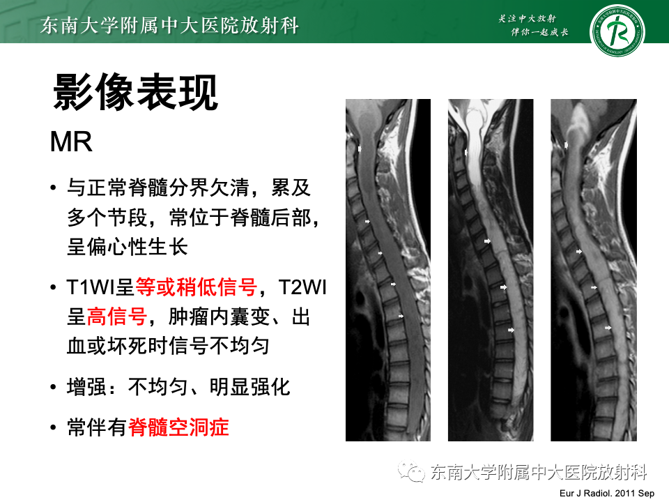 影像PPT - 【PPT】脊髓星形细胞瘤-19
