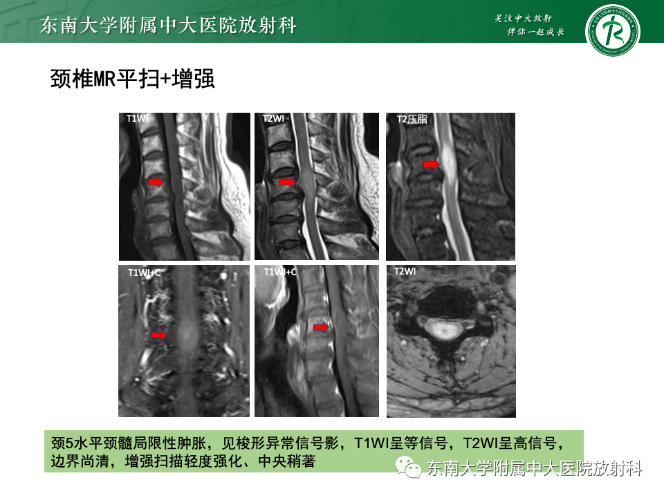 影像PPT - 【PPT】脊髓星形细胞瘤-24