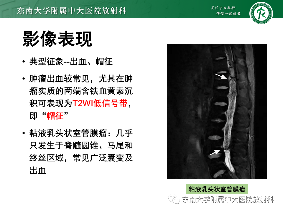 影像PPT - 【PPT】脊髓星形细胞瘤-27