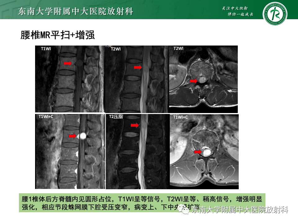 影像PPT - 【PPT】脊髓星形细胞瘤-28