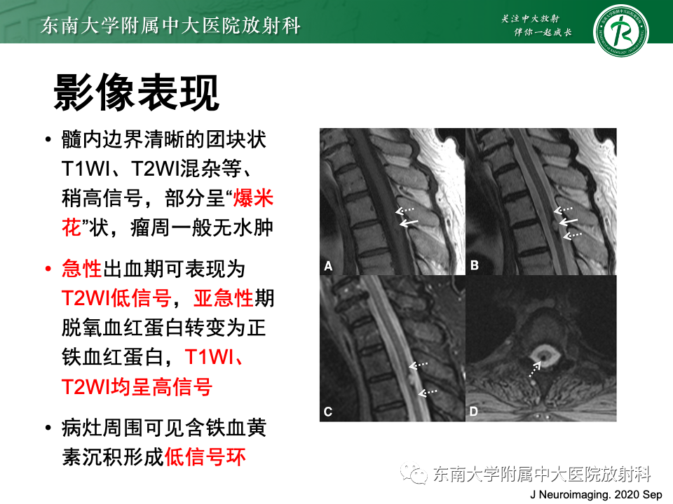 影像PPT - 【PPT】脊髓星形细胞瘤-33