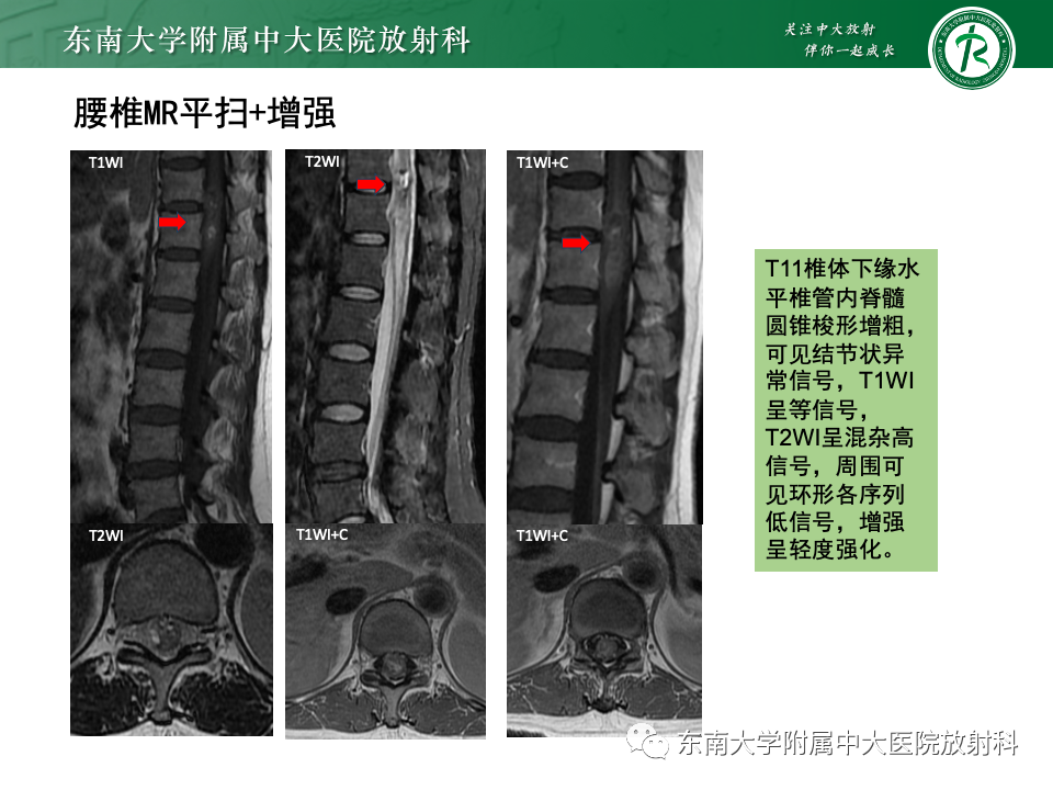 影像PPT - 【PPT】脊髓星形细胞瘤-31