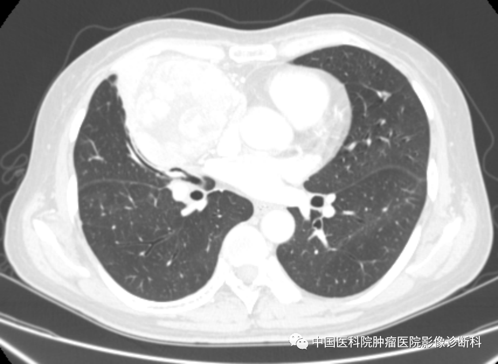影像PPT - 【病例】前纵隔胸腺瘤1例CT影像-5
