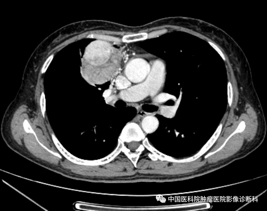 影像PPT - 【病例】前纵隔胸腺瘤1例CT影像-2