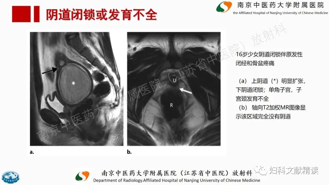 影像PPT - 【PPT】阴道病变影像诊断汇总-14 影像PPT - 【PPT】阴道病变影像诊断汇总-14